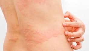 কোন ভিটামিনের অভাবে অ্যালার্জি হয়, জেনে নিন